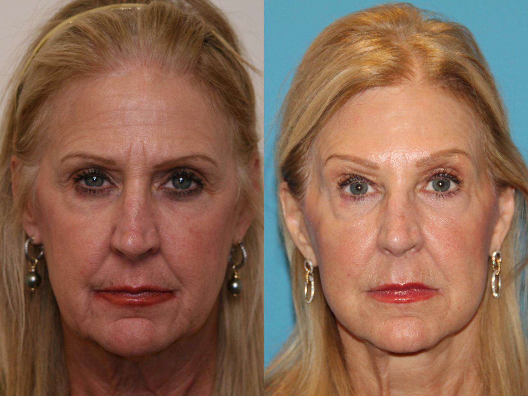 Before & After Facial Rejuvenation Case 45 View #1 View in Atlanta, Georgia