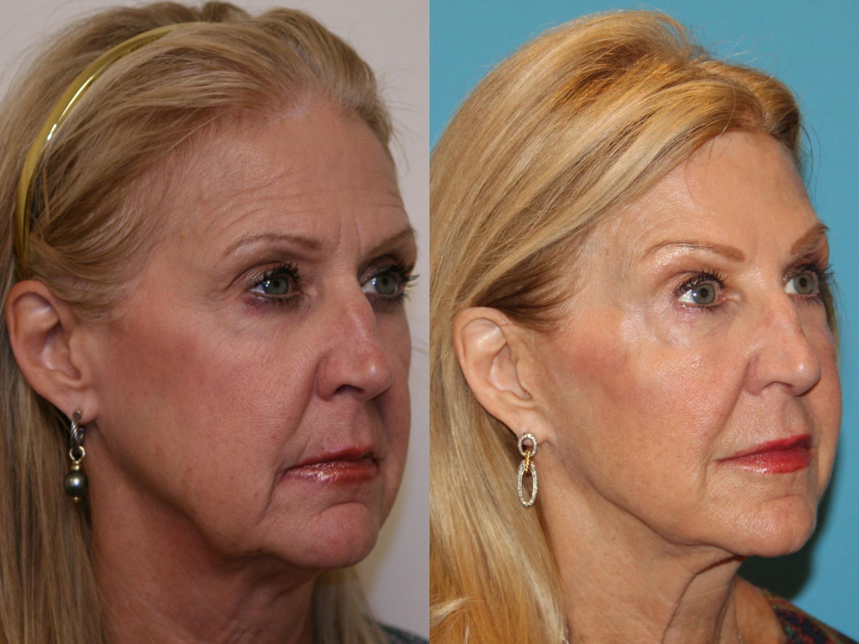 Before & After Facial Rejuvenation Case 45 View #2 View in Atlanta, Georgia