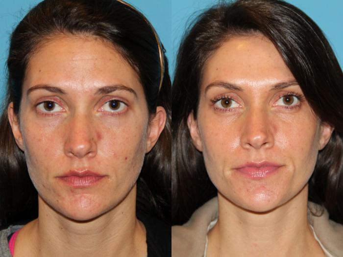 Before & After Facial Rejuvenation Case 92 View #1 View in Atlanta, Georgia