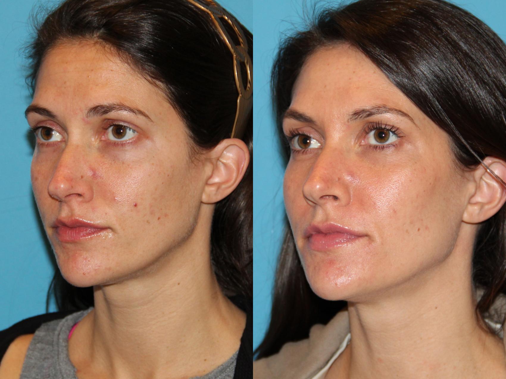 Facial Rejuvenation Before And After Pictures Case Atlanta Georgia Buckhead Facial