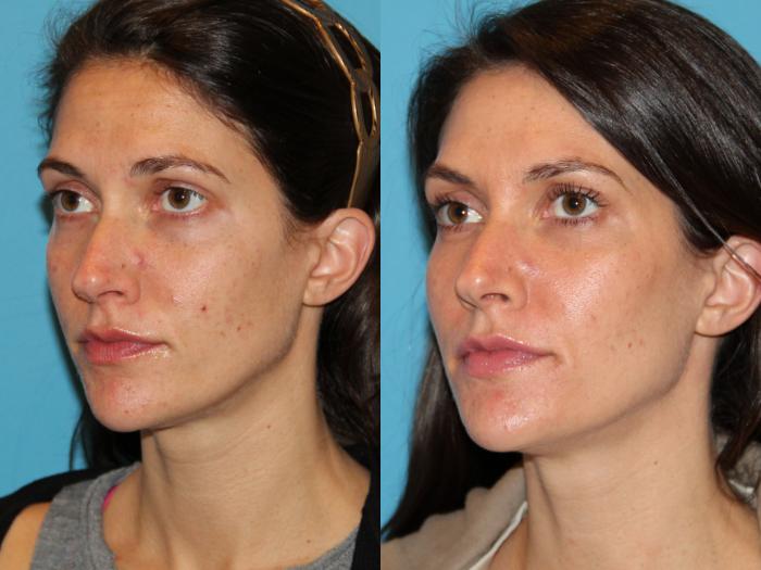 Before & After Facial Rejuvenation Case 92 View #2 View in Atlanta, Georgia