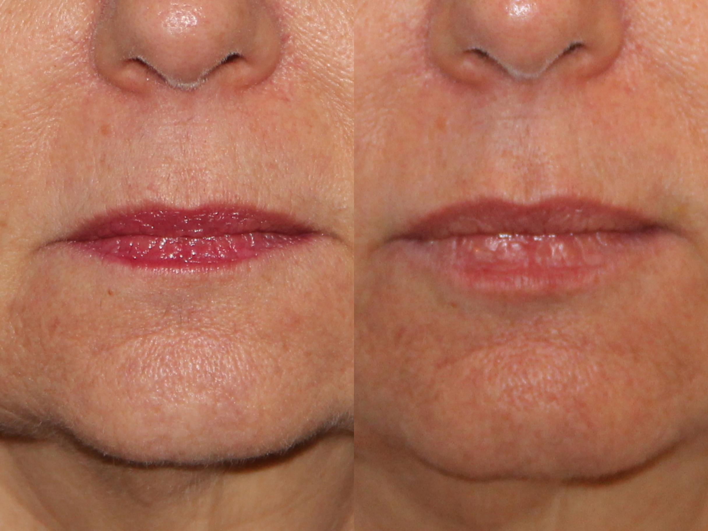 Dermal Fillers Before and After Pictures Case 96 Atlanta,