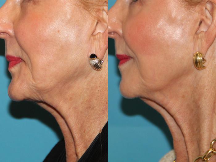 Before & After Laser Treatments Case 129 View #1 View in Atlanta, Georgia