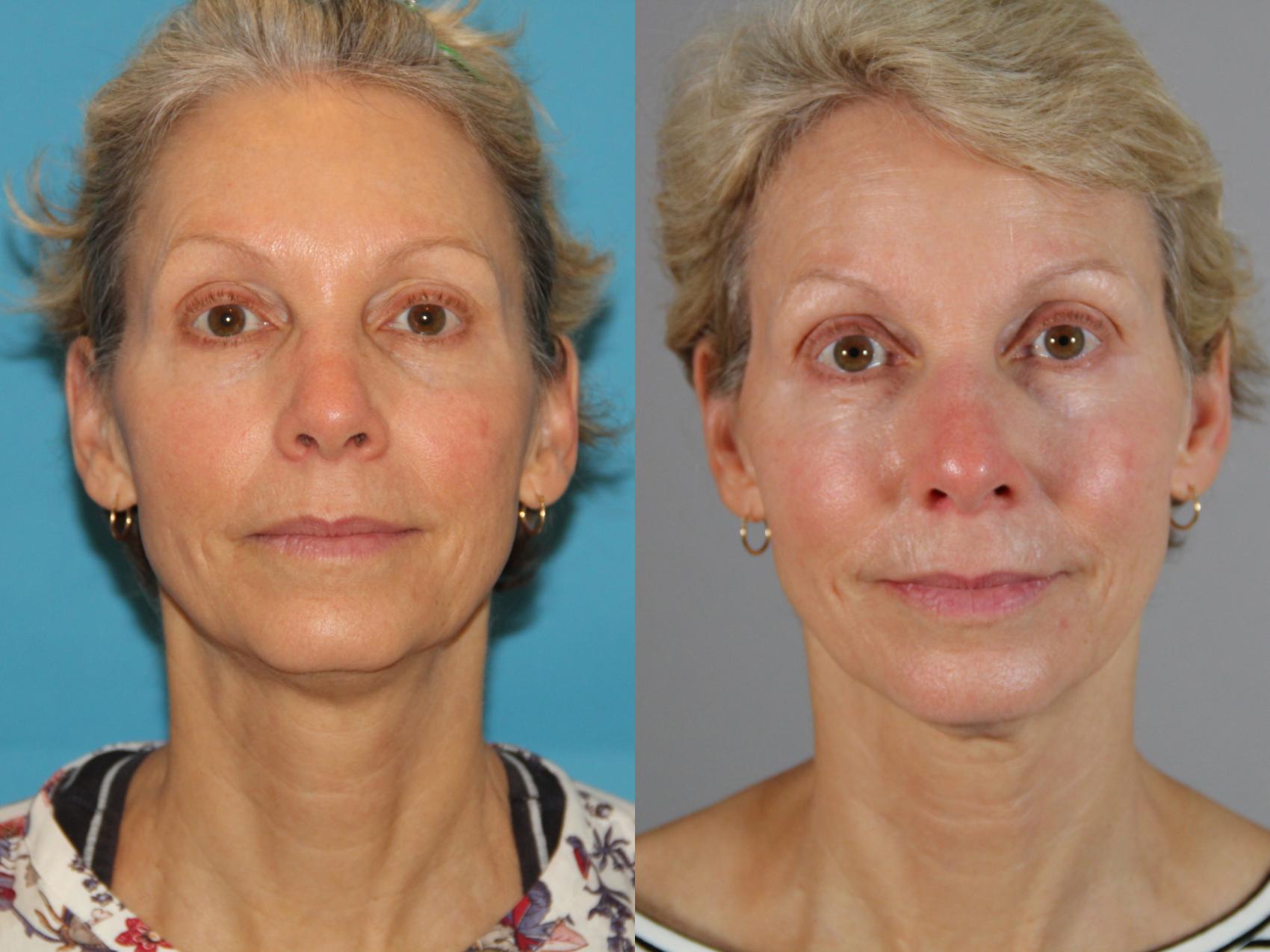 Before & After Laser Treatments Case 136 View #1 View in Atlanta, Georgia