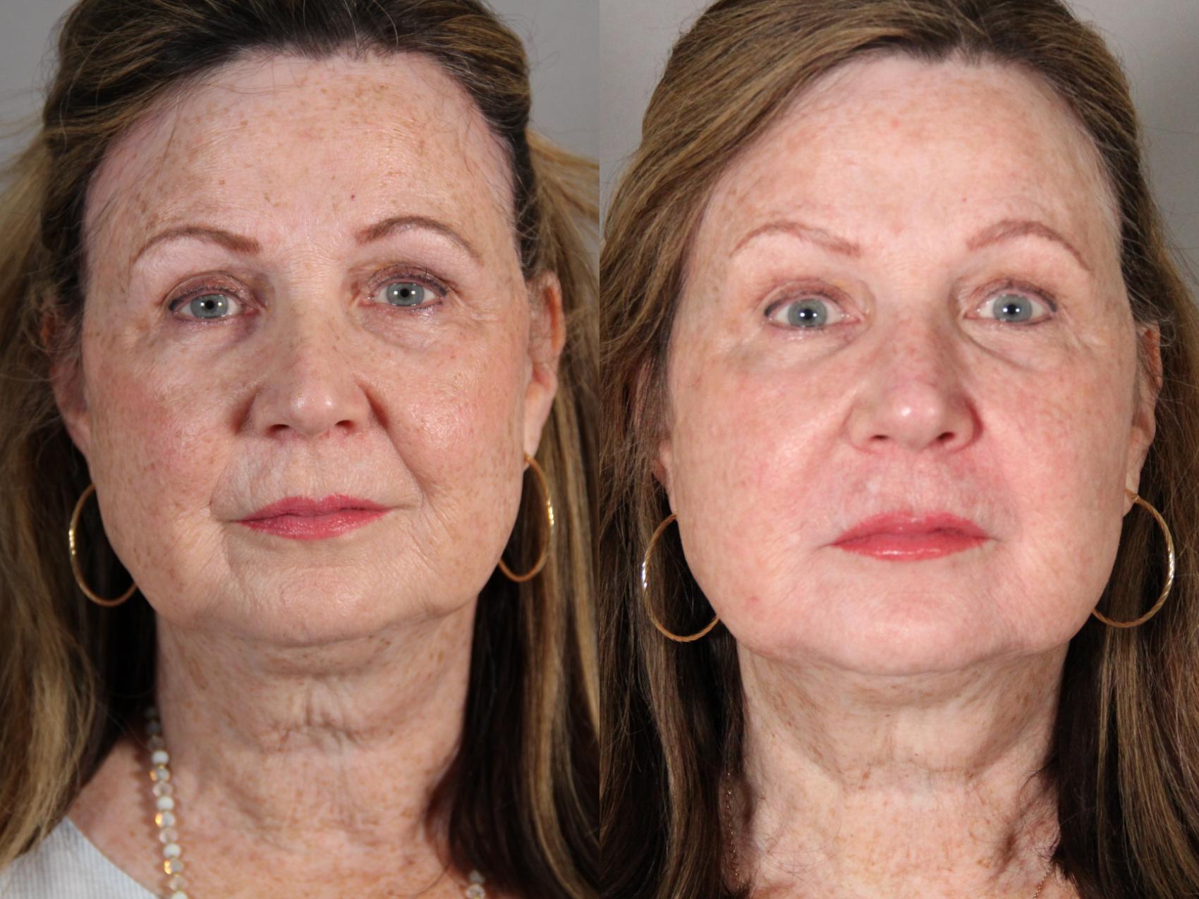 Before & After Laser Treatments Case 137 View #1 View in Atlanta, Georgia