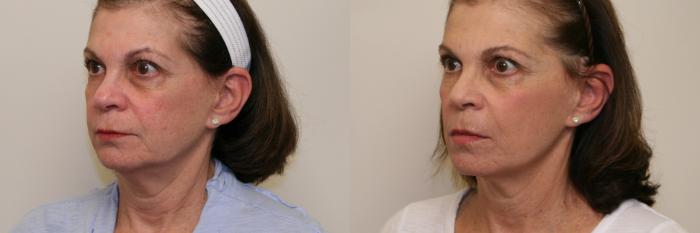 Before & After Laser Treatments Case 57 View #1 View in Atlanta, Georgia