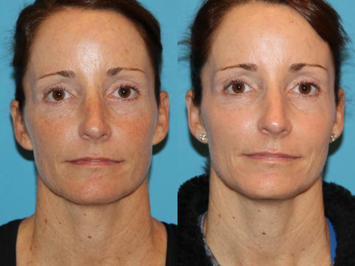 Before & After Laser Treatments Case 75 View #1 View in Atlanta, Georgia