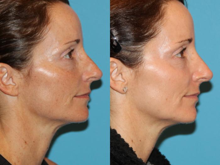 Before & After Laser Treatments Case 75 View #2 View in Atlanta, Georgia