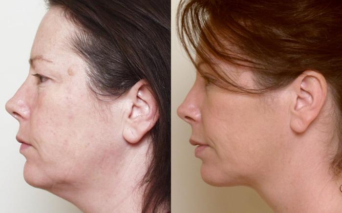 Before & After Neck Lift (Submentoplasty) Case 13 View #2 View in Atlanta, Georgia