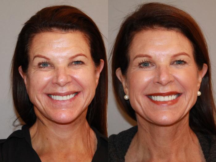 Before & After Neck Lift (Submentoplasty) Case 142 Front View in Atlanta, Georgia
