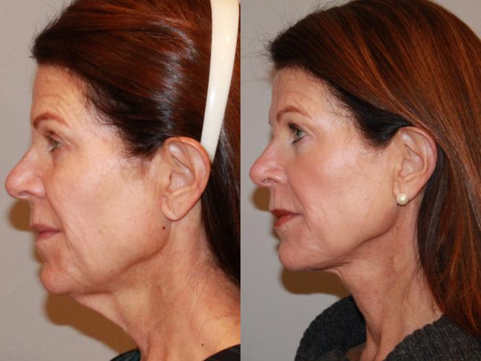 Before & After Neck Lift (Submentoplasty) Case 142 Left Side View in Atlanta, Georgia