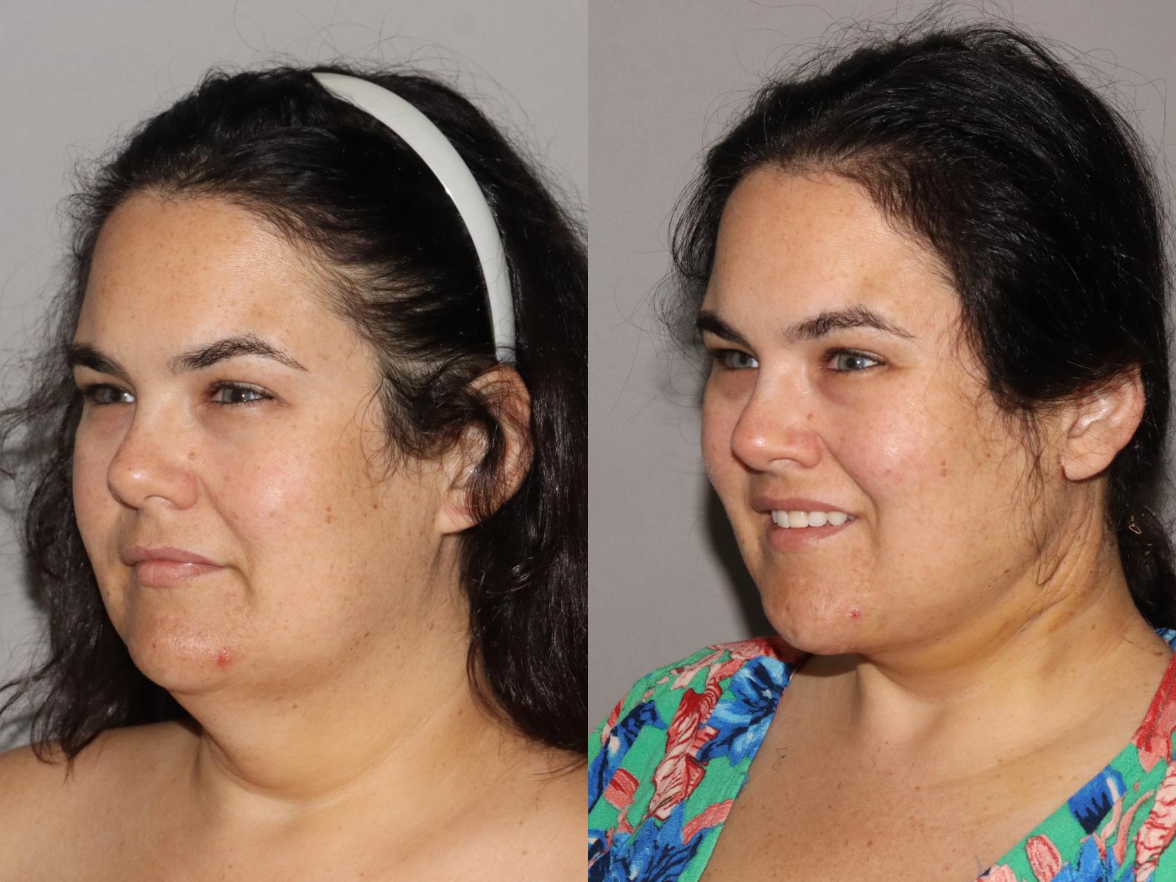 Before & After Neck Lift (Submentoplasty) Case 154 Left Oblique View in Atlanta, Georgia