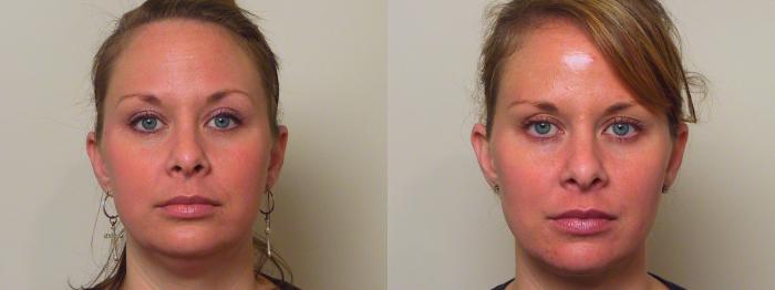 Before & After Neck Lift (Submentoplasty) Case 37 View #1 View in Atlanta, Georgia