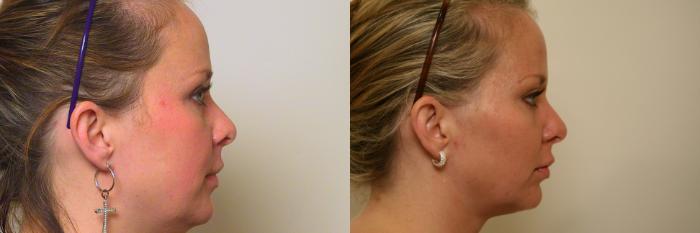 Before & After Neck Lift (Submentoplasty) Case 37 View #2 View in Atlanta, Georgia