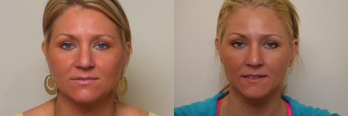 Before & After Neck Lift (Submentoplasty) Case 50 View #2 View in Atlanta, Georgia