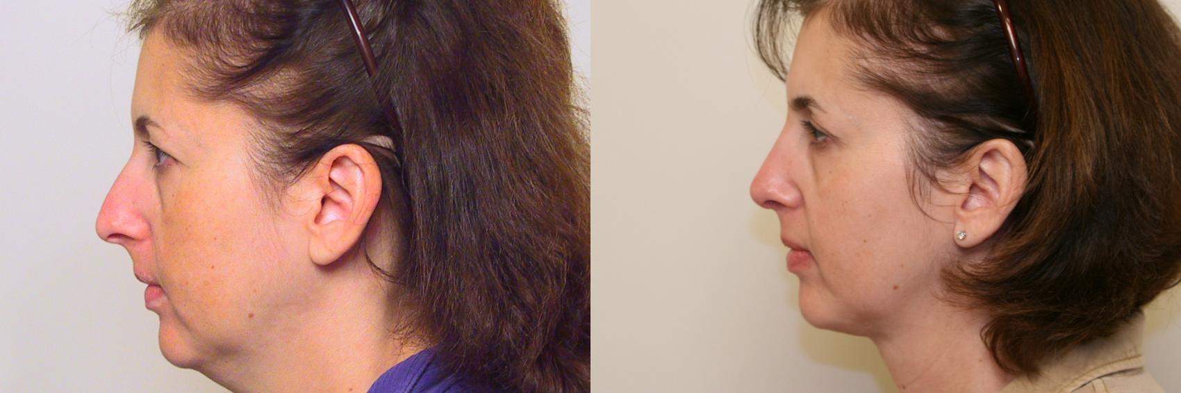 Before & After Neck Lift (Submentoplasty) Case 56 View #1 View in Atlanta, Georgia