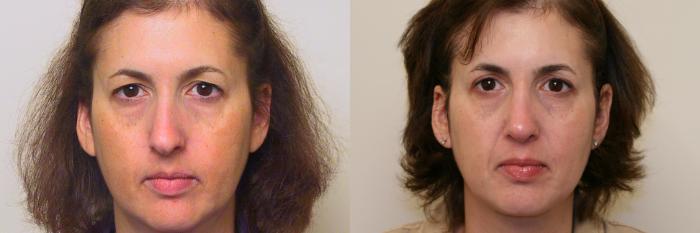 Before & After Neck Lift (Submentoplasty) Case 56 View #2 View in Atlanta, Georgia