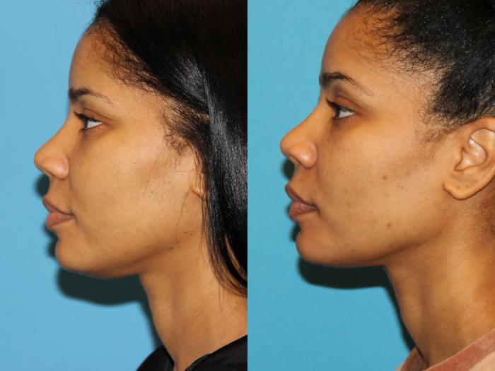 Before & After Neck Lift (Submentoplasty) Case 94 View #1 View in Atlanta, Georgia