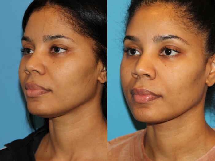 Before & After Neck Lift (Submentoplasty) Case 94 View #2 View in Atlanta, Georgia