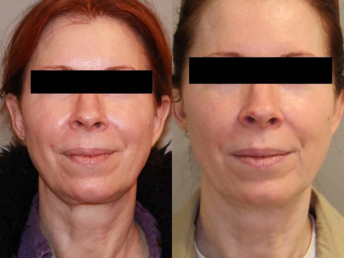 Best Natural Facelift Atlanta, GA