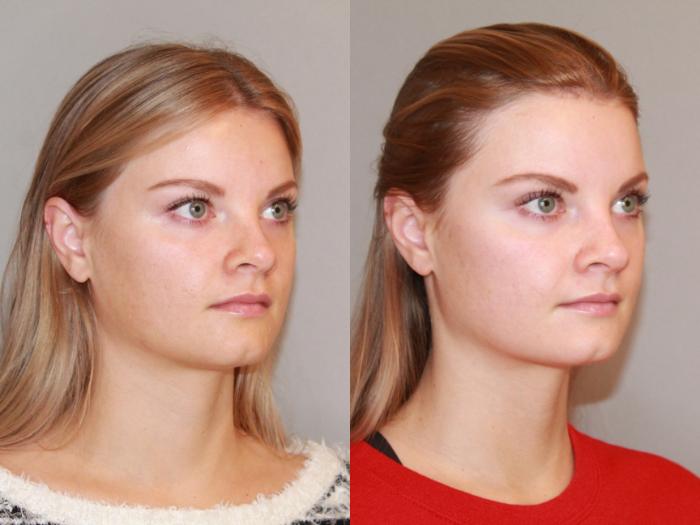 Best Natural Facelift Atlanta, GA