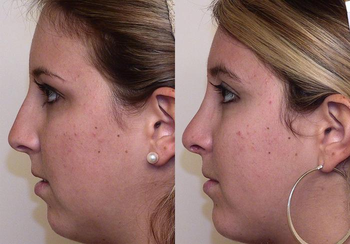 Before & After Rhinoplasty Case 1 View #1 View in Atlanta, Georgia