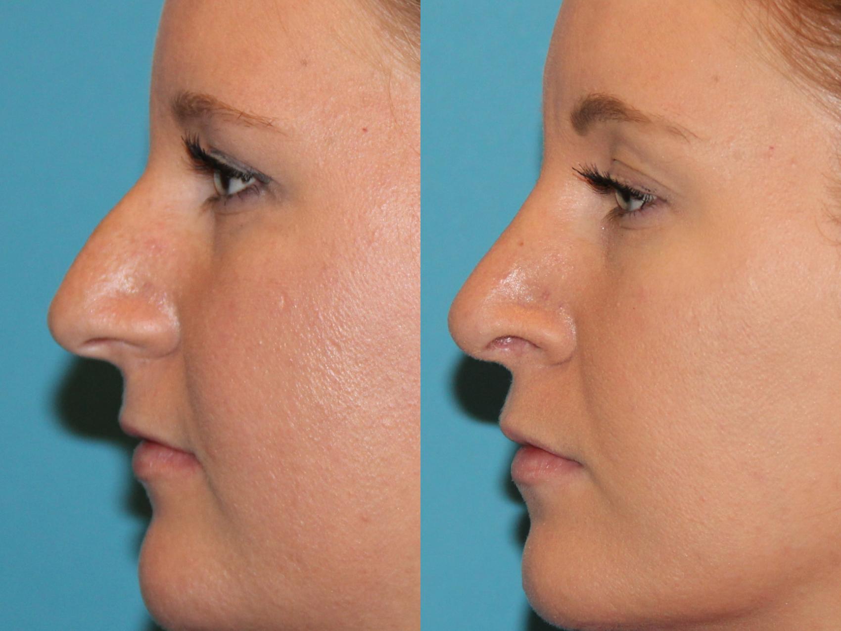 Before & After Rhinoplasty Case 113 View #1 View in Atlanta, Georgia
