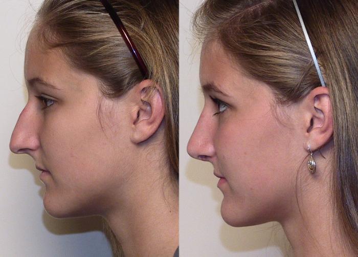 Before & After Rhinoplasty Case 12 View #1 View in Atlanta, Georgia