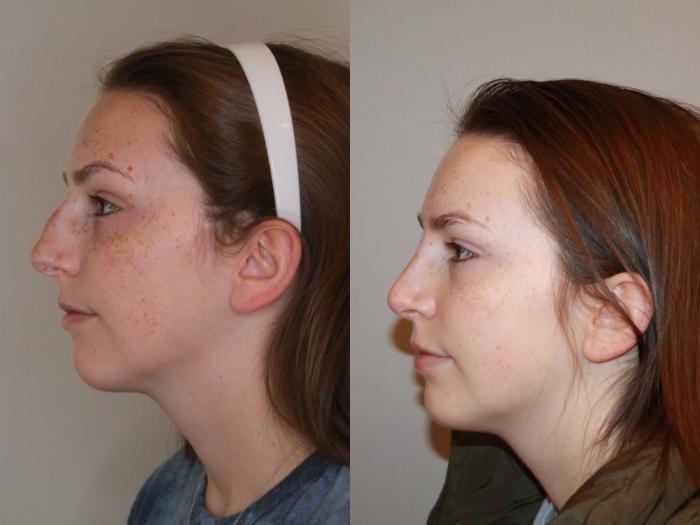 Before & After Rhinoplasty Case 143 Left Side View in Atlanta, Georgia