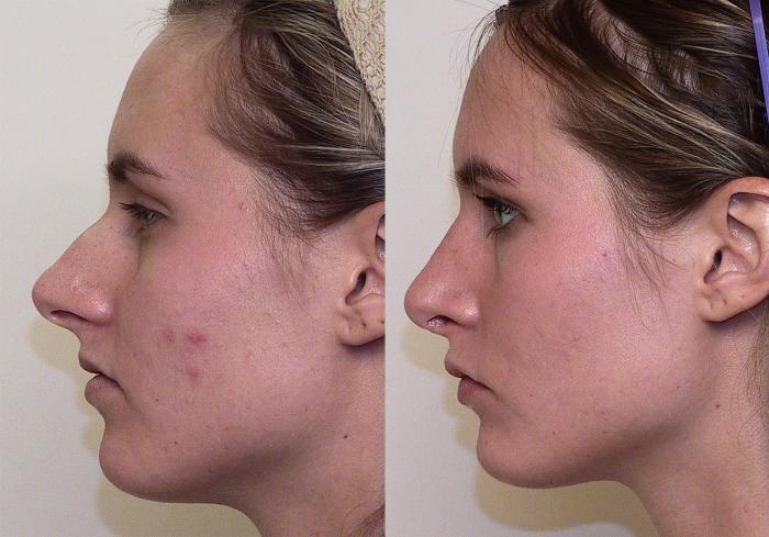 Before & After Rhinoplasty Case 2 View #1 View in Atlanta, Georgia