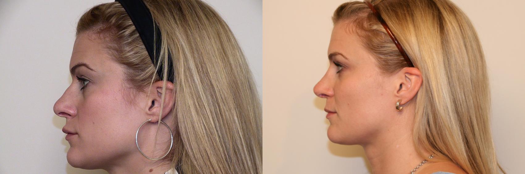 Before & After Rhinoplasty Case 28 View #1 View in Atlanta, Georgia