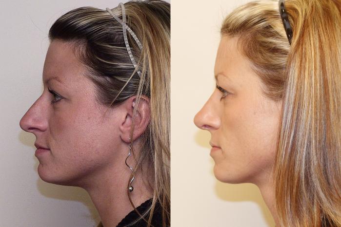 Before & After Rhinoplasty Case 29 View #1 View in Atlanta, Georgia