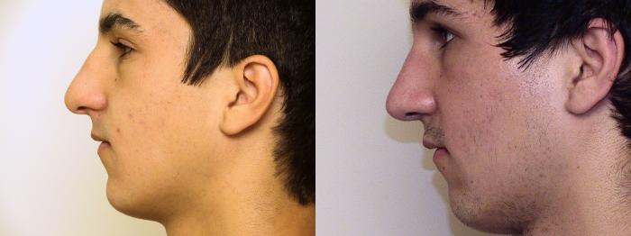 Before & After Rhinoplasty Case 55 View #1 View in Atlanta, Georgia