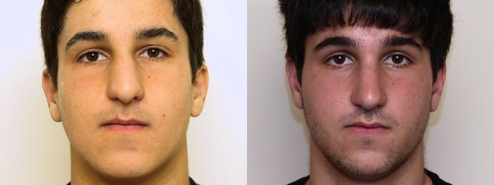 Before & After Rhinoplasty Case 55 View #2 View in Atlanta, Georgia