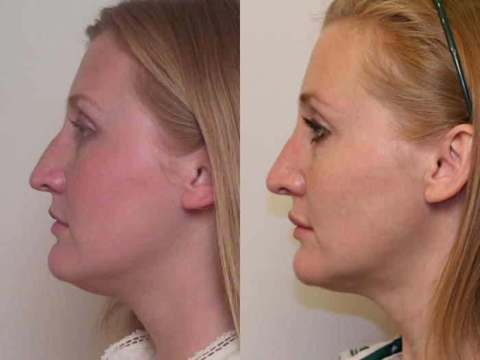 Before & After Rhinoplasty Case 63 View #1 View in Atlanta, Georgia