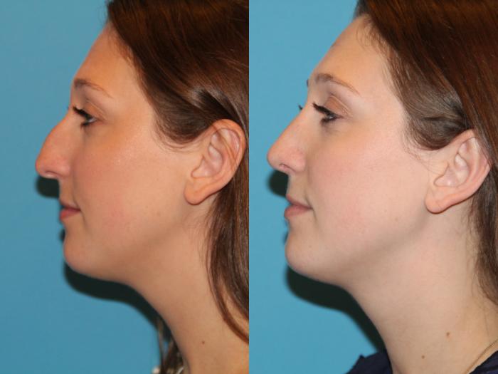 Before & After Rhinoplasty Case 76 View #1 View in Atlanta, Georgia