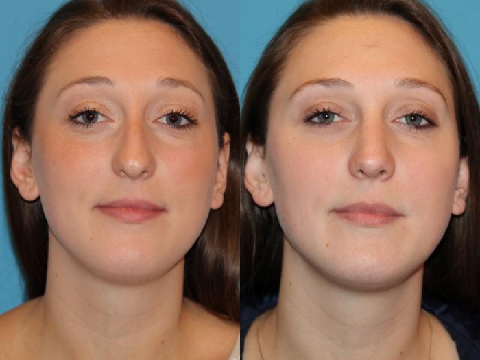 Before & After Rhinoplasty Case 76 View #2 View in Atlanta, Georgia