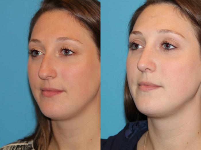 Before & After Rhinoplasty Case 76 View #3 View in Atlanta, Georgia