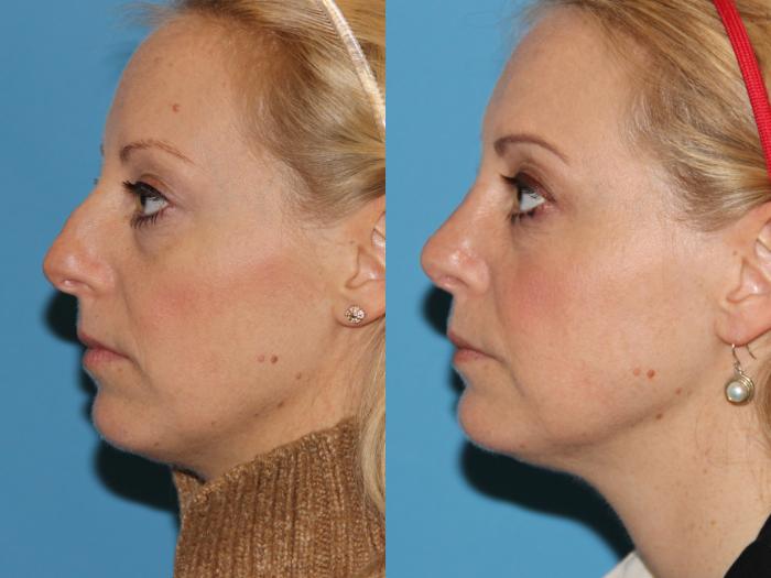 Before & After Rhinoplasty Case 91 View #1 View in Atlanta, Georgia