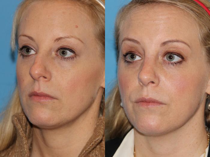 Before & After Rhinoplasty Case 91 View #2 View in Atlanta, Georgia