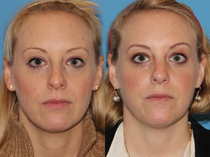 Before & After Rhinoplasty Case 91 View #3 View in Atlanta, Georgia