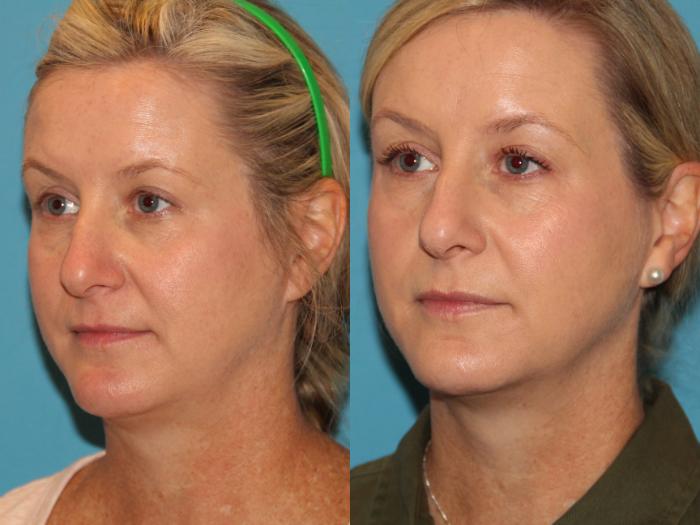 Before & After Sculptra® Case 110 View #1 View in Atlanta, Georgia