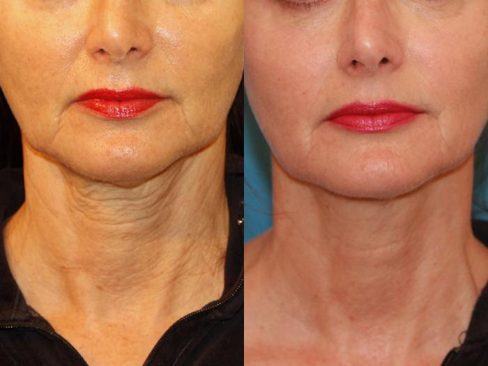 Before & After Sculptra® Case 114 View #1 View in Atlanta, Georgia