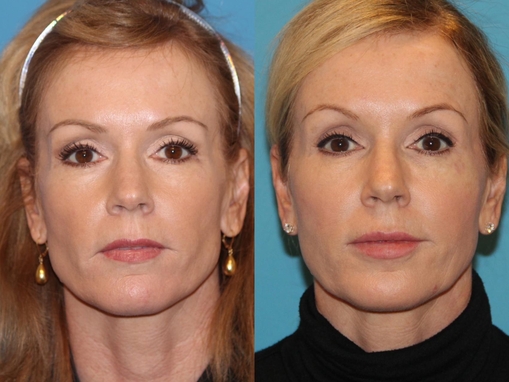 Before & After Facial Rejuvenation Case 118 View #1 View in Atlanta, Georgia