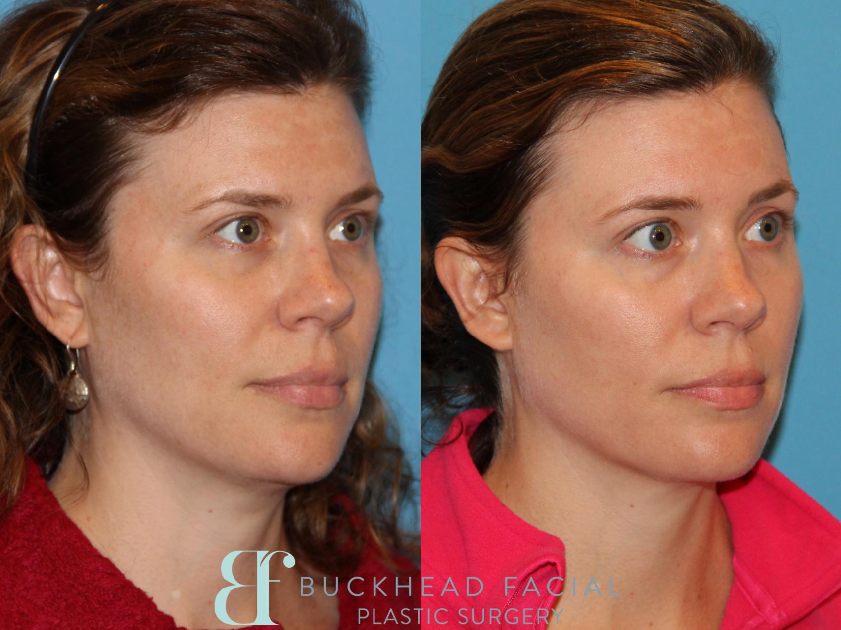 Sculptra Case 121