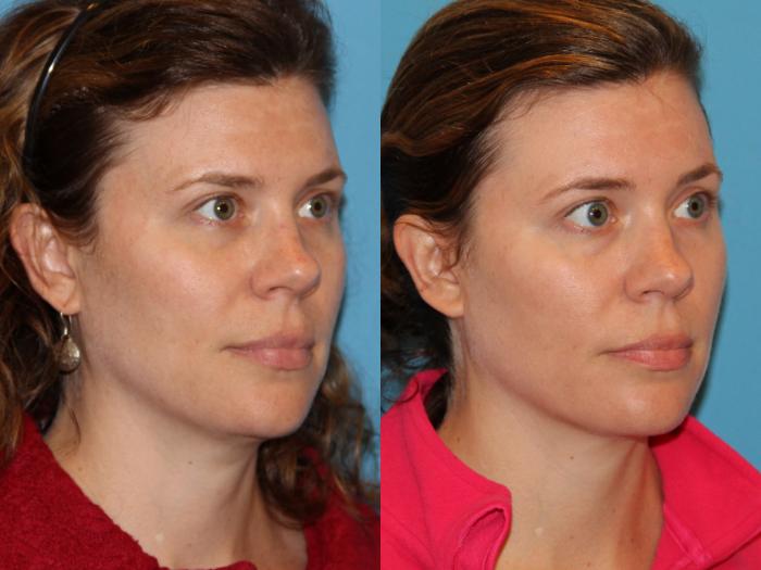 Before & After Sculptra® Case 121 View #1 View in Atlanta, Georgia