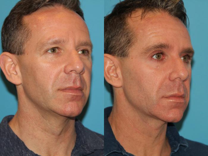 Before & After Sculptra® Case 122 View #1 View in Atlanta, Georgia