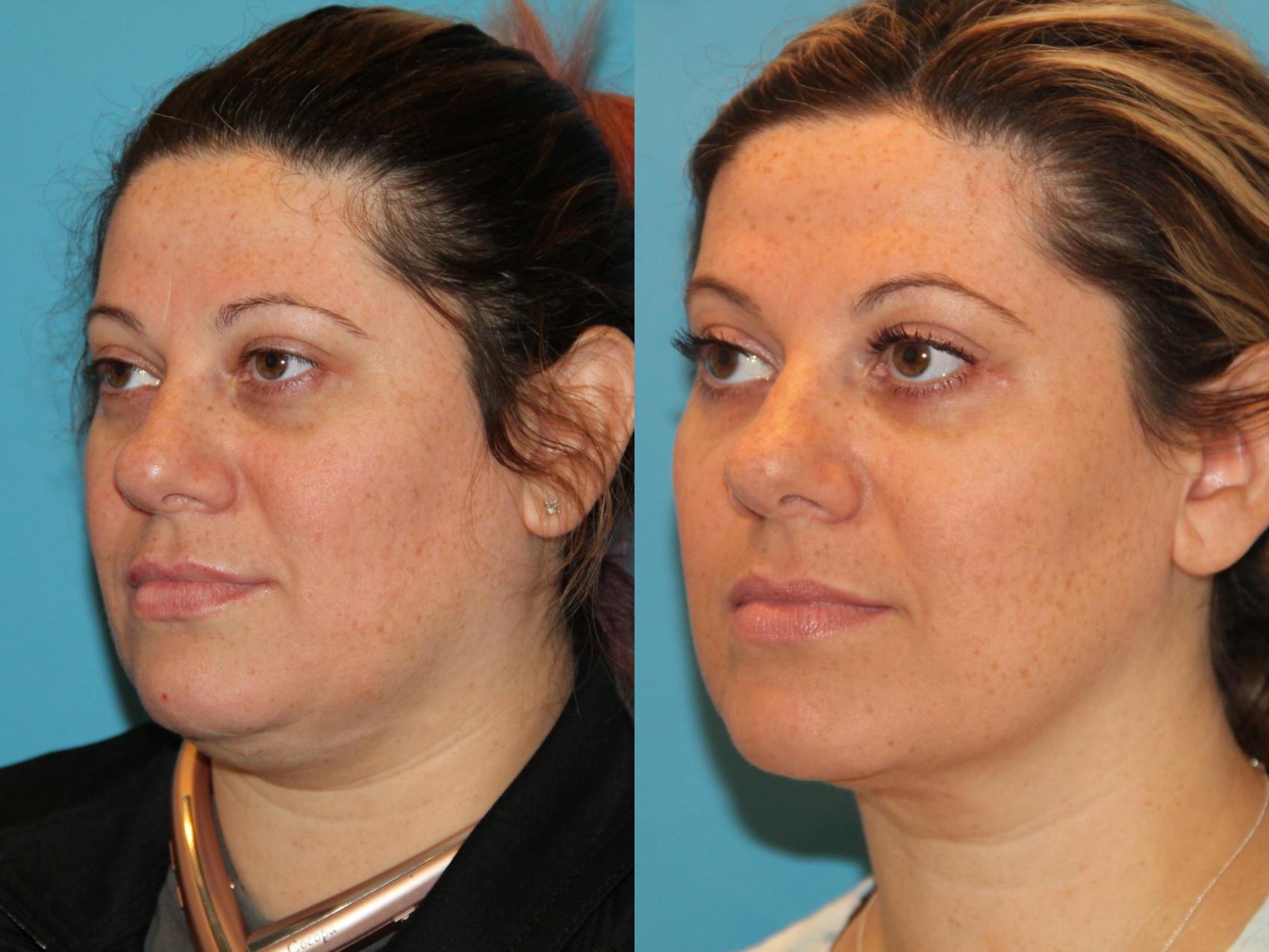 Before & After Sculptra® Case 131 View #1 View in Atlanta, Georgia