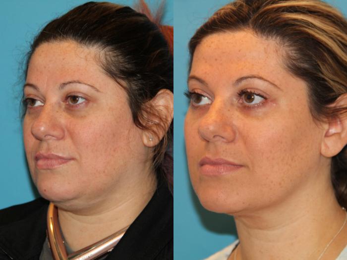 Before & After Sculptra® Case 131 View #1 View in Atlanta, Georgia