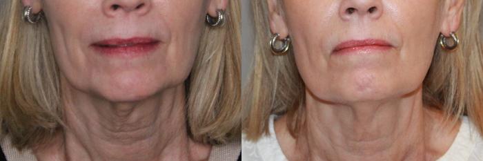 Before & After Sculptra® Case 152 Front View in Atlanta, Georgia